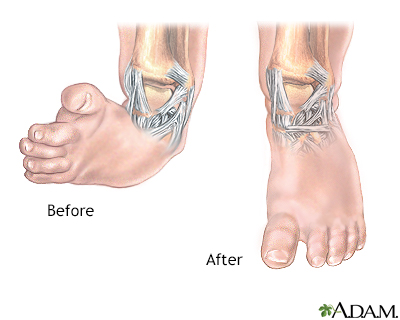 Club foot deformity